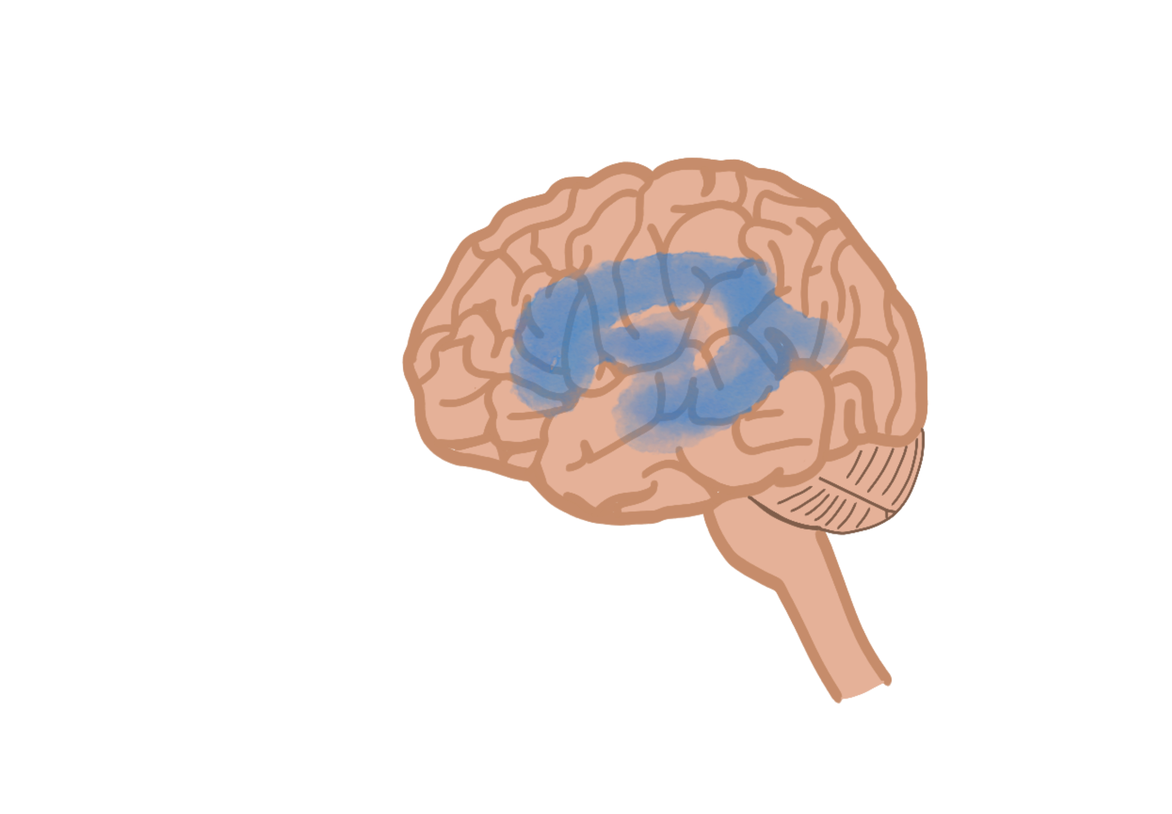 正常壓力水腦症腦室系統示意圖